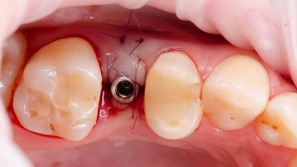 Delayed implantation in the area of 1.5 tooth