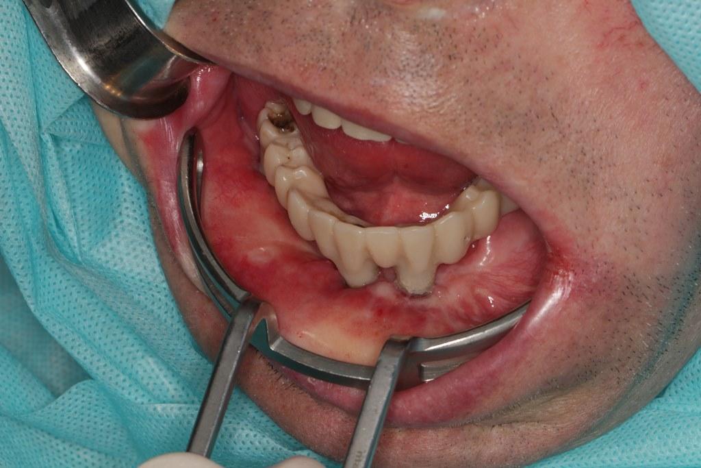 Reconstruction of the lower jaw using a fibular autograft with dental implantation and immediate crown loading