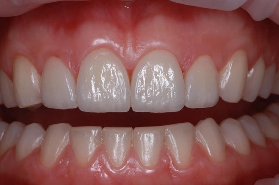 E-max veneers after orthodontic treatment