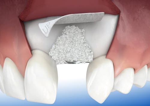 Bone tissue extension when implanting teeth