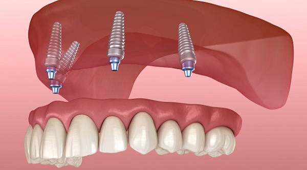 Should I Postpone Dental Implants?