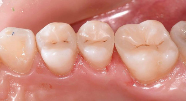 Treatment of dental caries by a direct method using modern composite materials