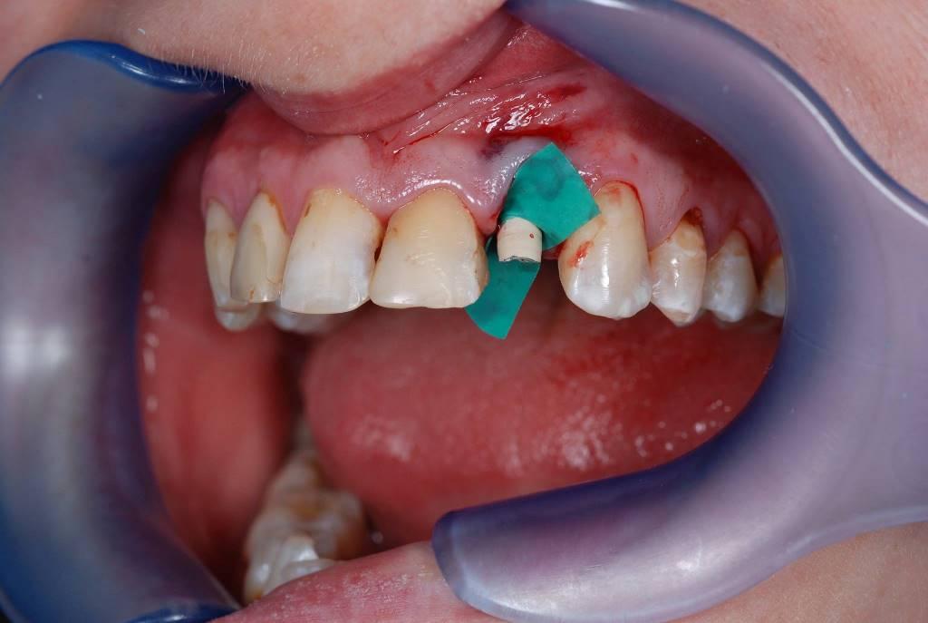 Tooth extraction with simultaneous implantation