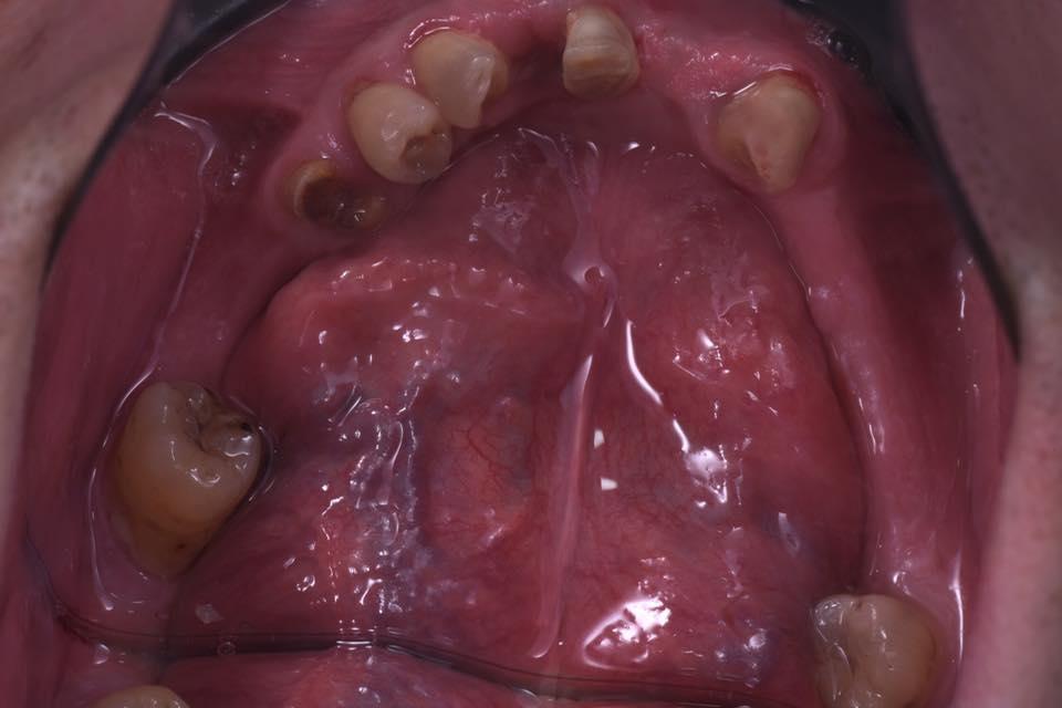 Rehabilitation of the patient using the all-on-6 technique simultaneously with the extraction of teeth on the upper and lower jaw