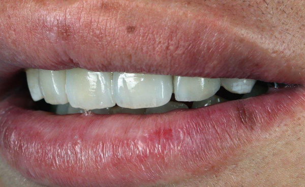 Immediate dental implantation in the area of the central incisor and restoration of the aesthetic profile in the front area