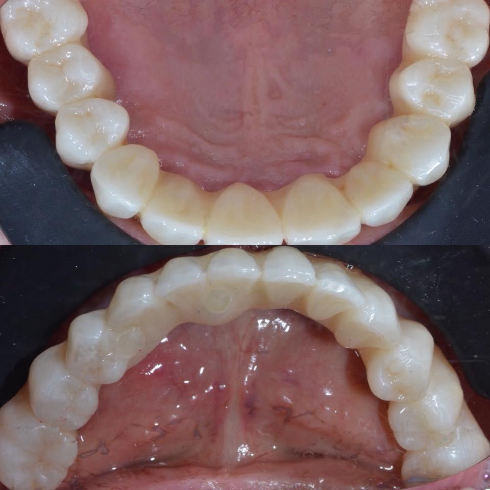 Full restoration of dentition with simultaneous implantation and immediate loading