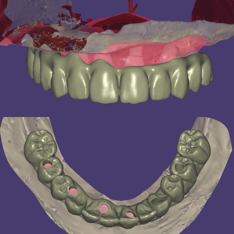 Full restoration of dentition with simultaneous implantation and immediate loading