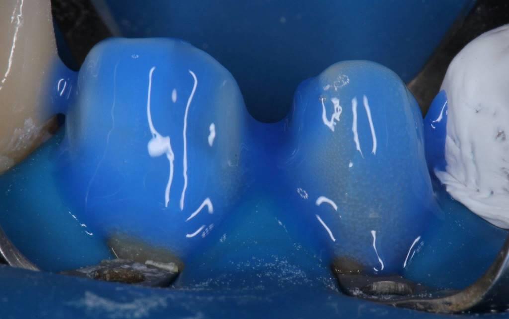 Aesthetic smile rehabilitation with lithium disilicate ceramic restorations