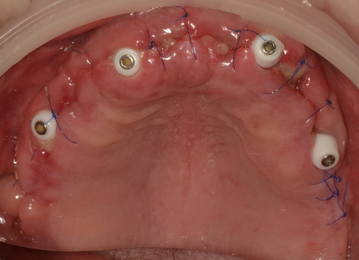 Removing teeth on the upper jaw and installing four Nobel implants in the concept ‘ALL-ON-4’