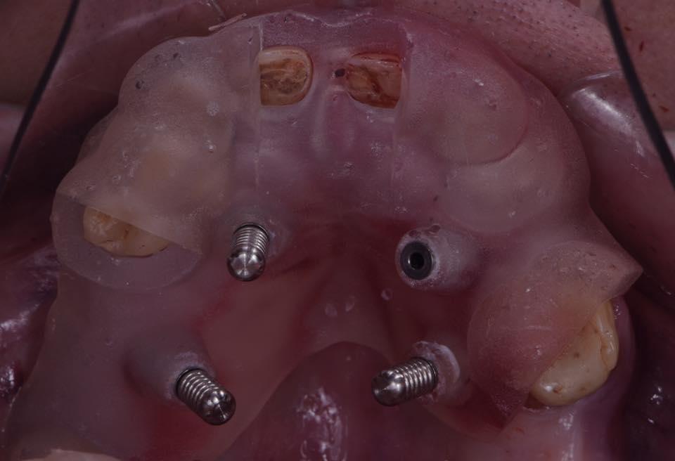 Rehabilitation of the patient using the all-on-6 technique simultaneously with the extraction of teeth on the upper and lower jaw