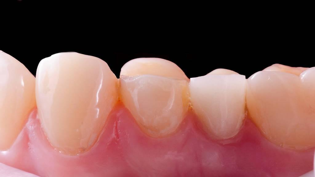 Delayed implantation in the area of 1.5 tooth