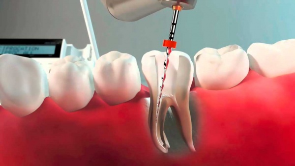 Root canal filling methods